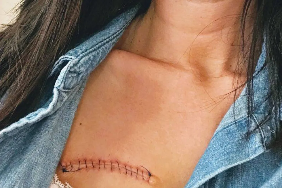 leah's scar