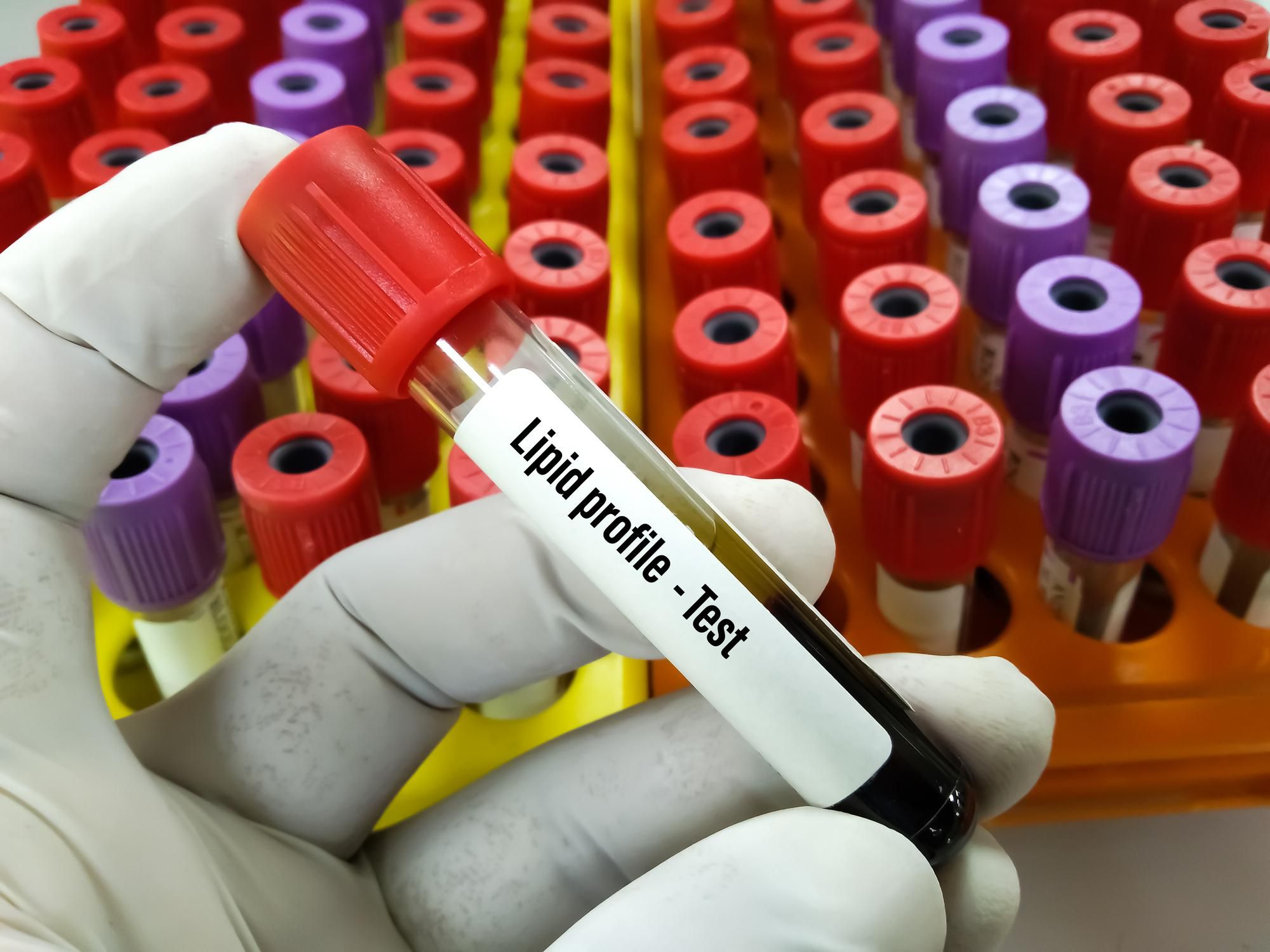 Lipid profile test at medical laboratory