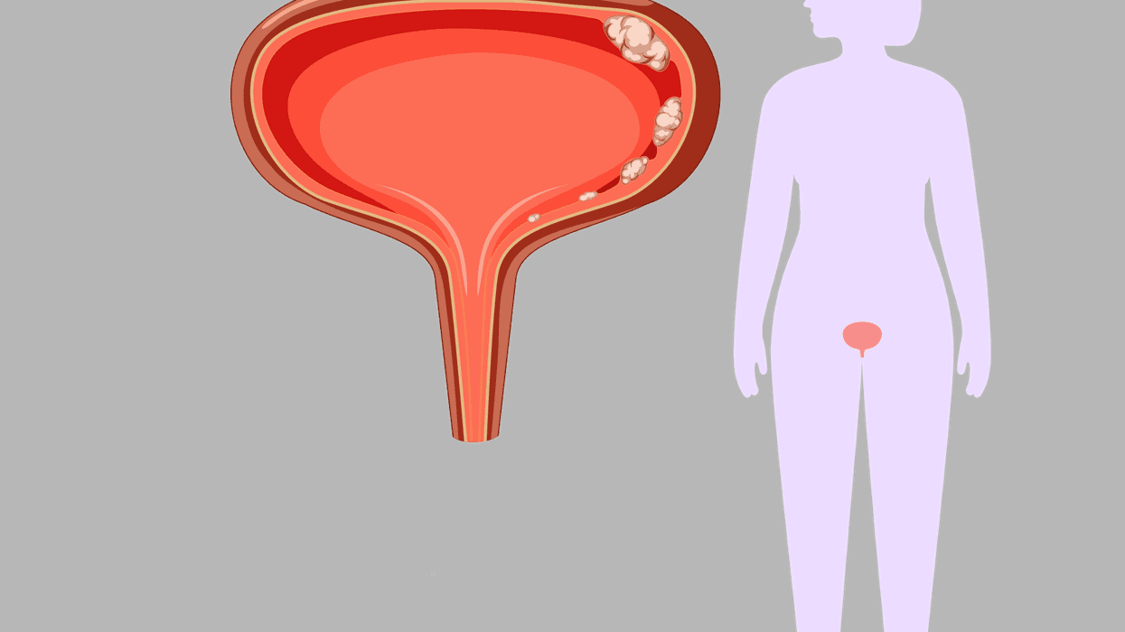 Living with Bladder Cancer