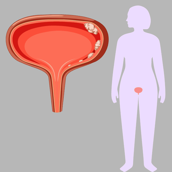 Living with Bladder Cancer