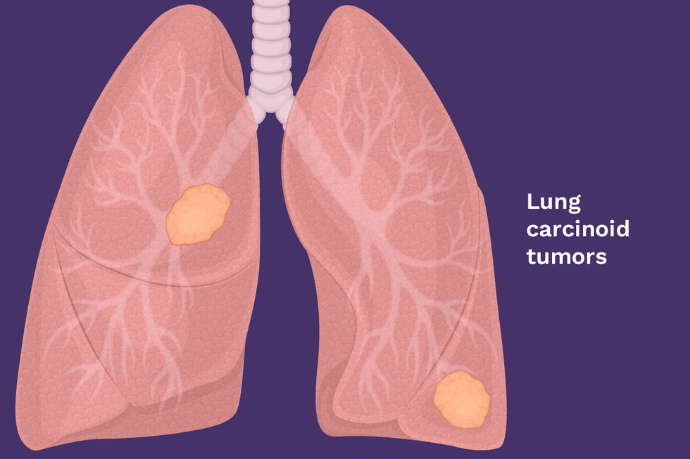 Tumor paru-paru yang bersifat kanker