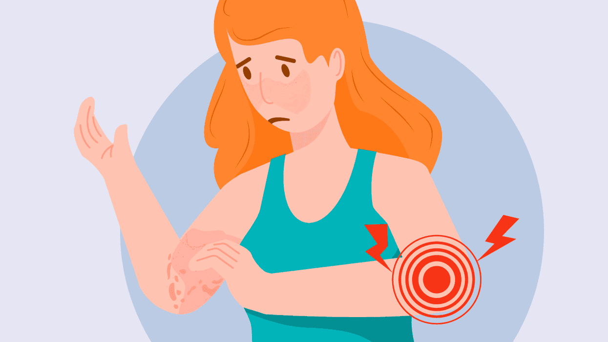 Lupus Triggers infographic