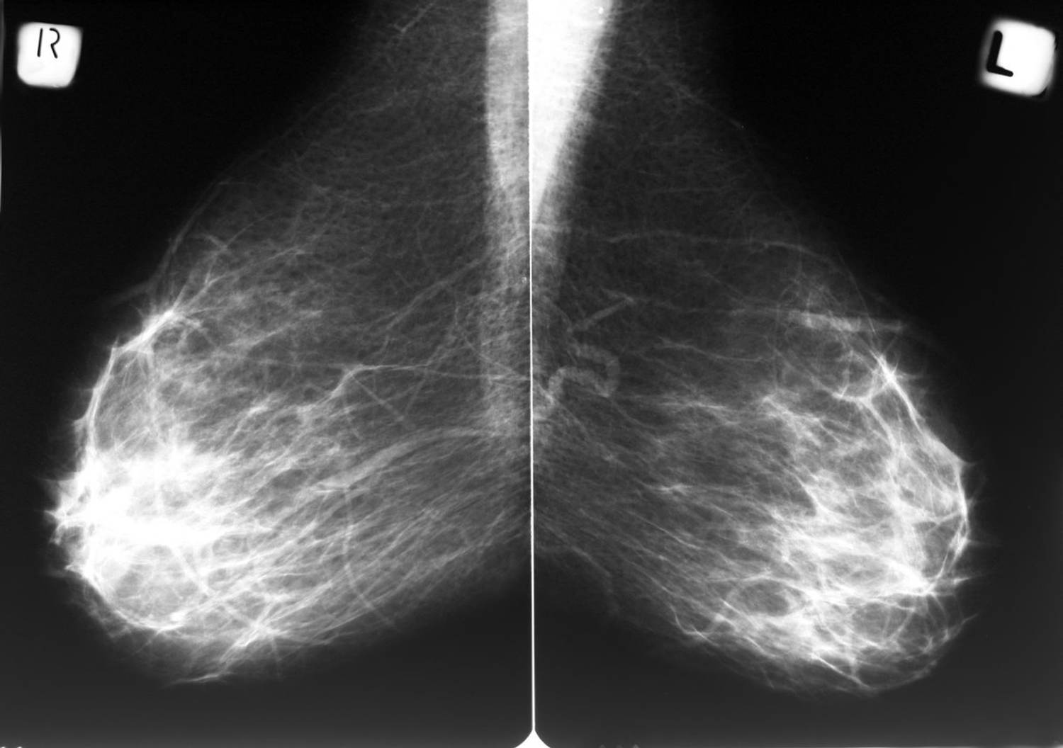 What You Should Know About Dense Breasts