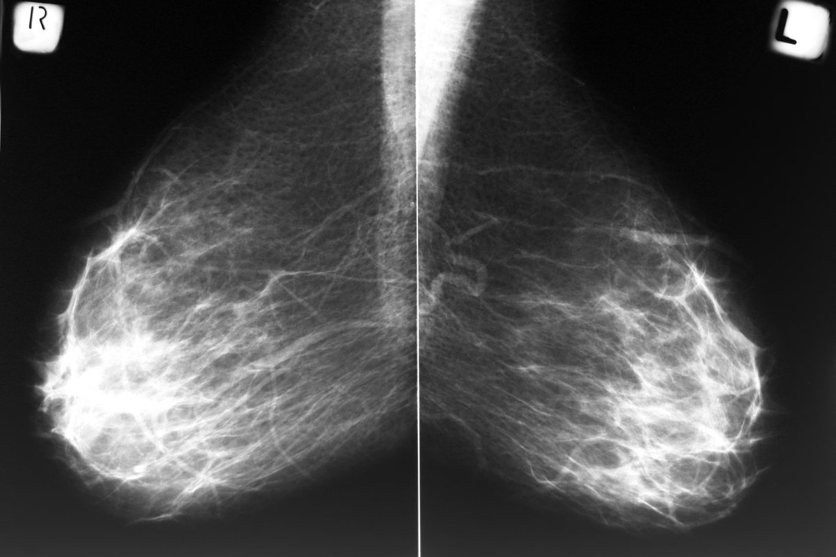 Mammogram films of both breasts of a female patient