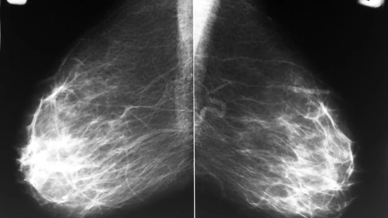 What You Should Know About Dense Breasts