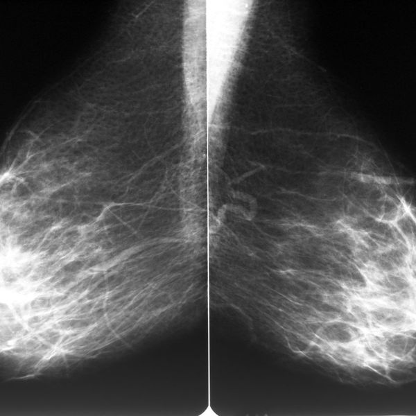 Mammogram films of both breasts of a female patient