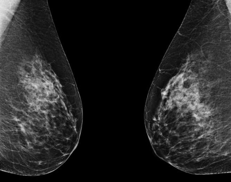 Mammography