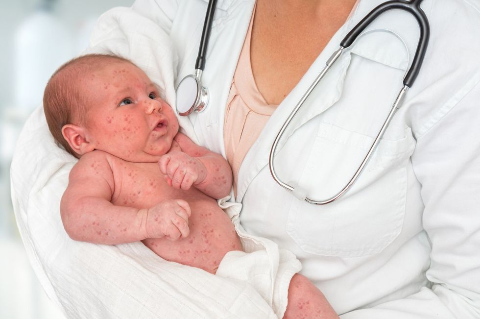 Measles Outbreak: What You Need to Know Now