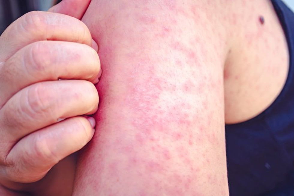 Measles, Woman scratches the upper arm with one hand due to the numerous red pruritus