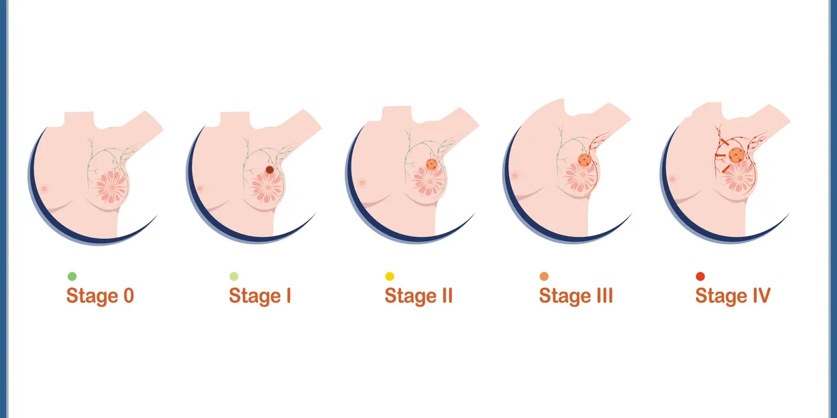 Stages of Breast Cancer – HealthyWomen