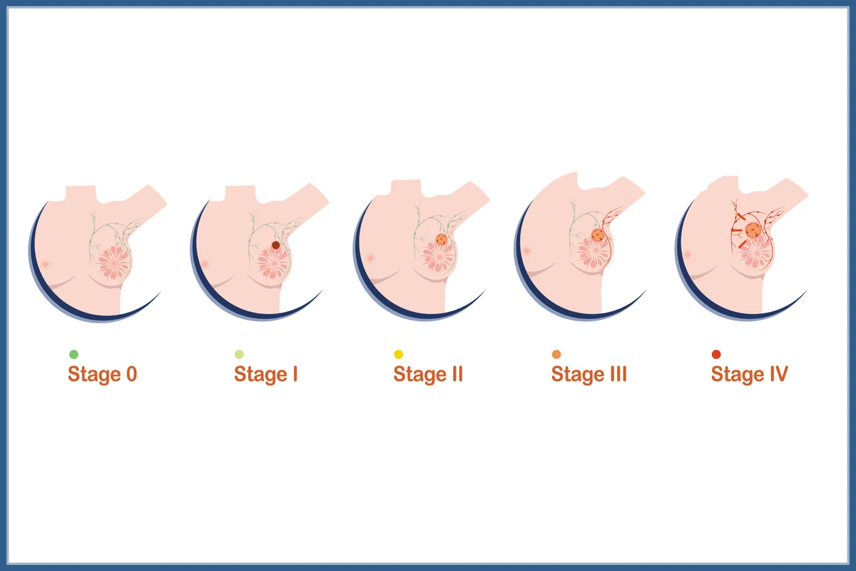 Medical illustration vector concept,female breasts and four levels of breast cancer severity