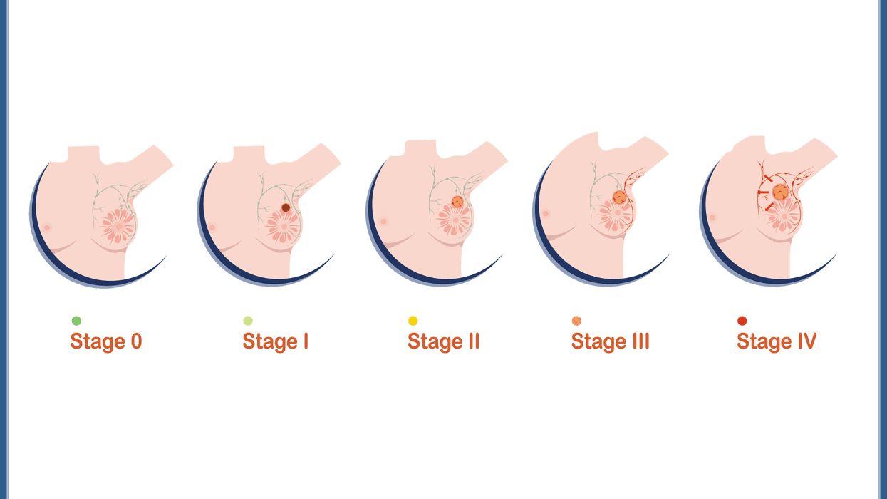 Stages of Breast Cancer