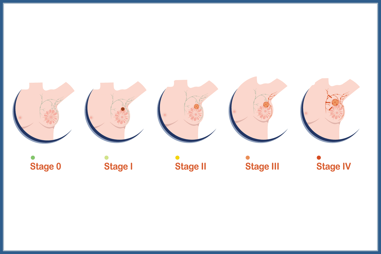 Stages of Breast Cancer
