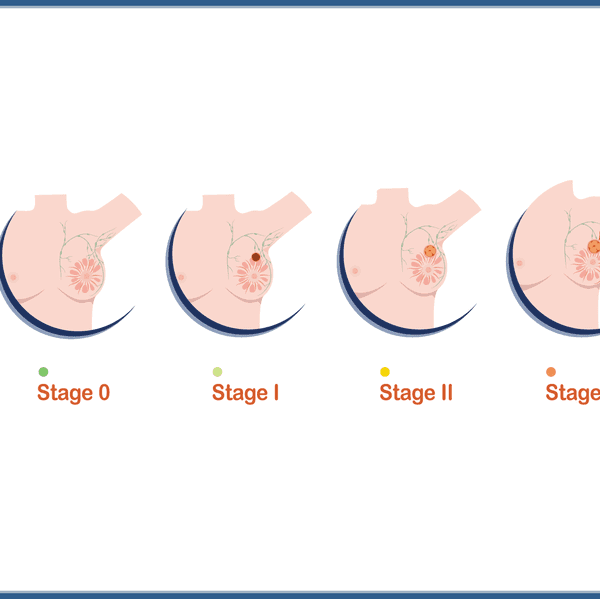 Medical illustration vector concept,female breasts and four levels of breast cancer severity
