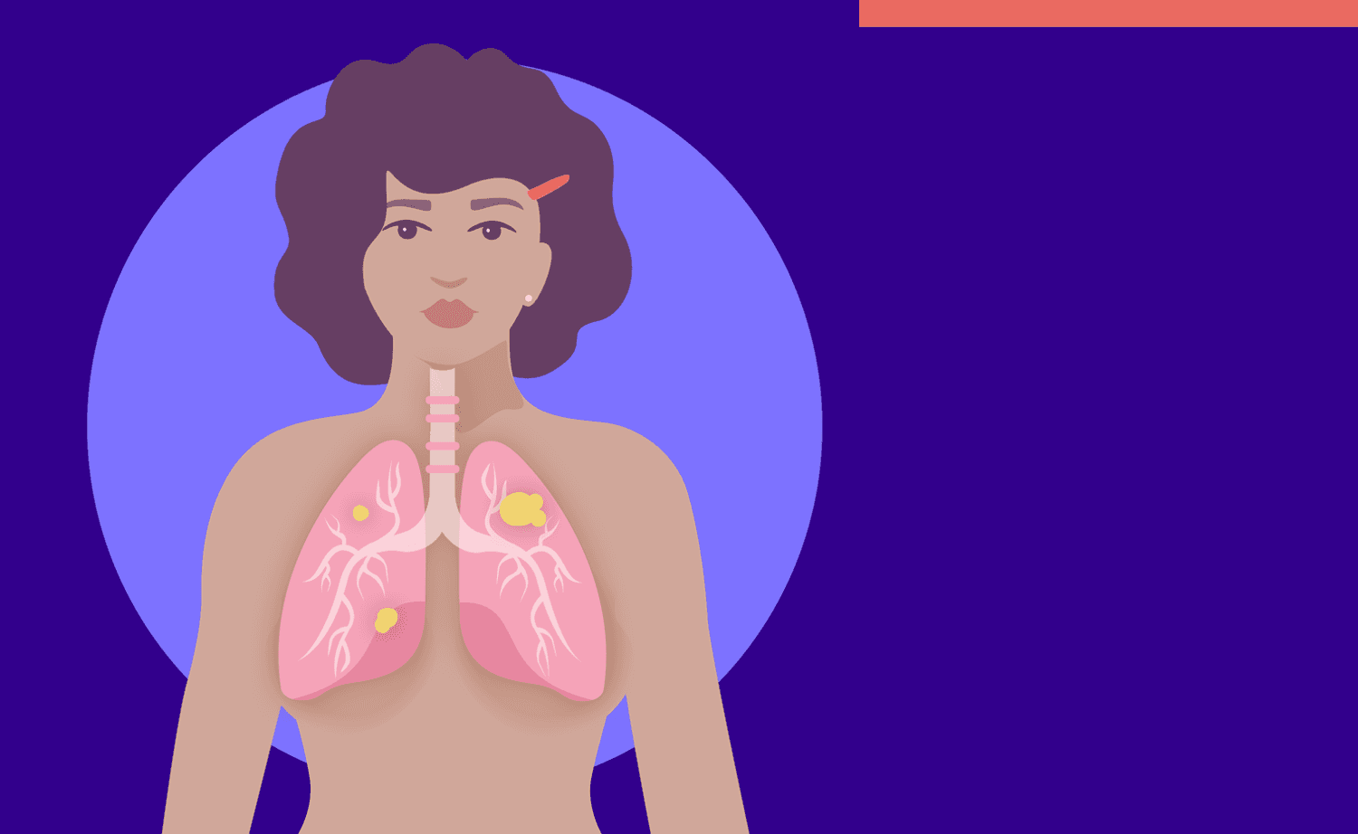 Mujeres que nunca han fumado pueden desarrollar cáncer pulmonar