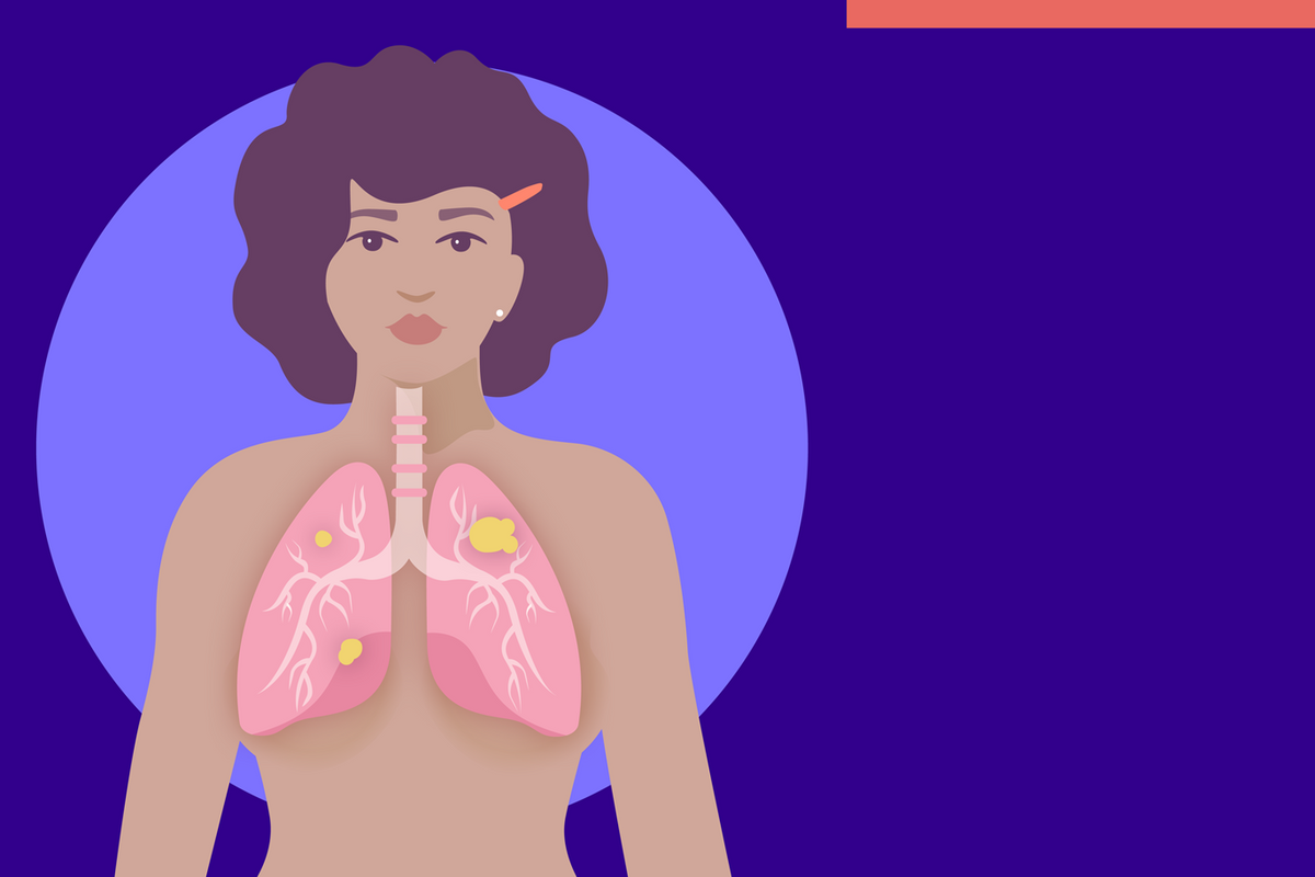  Mujeres que nunca han fumado pueden desarrollar cáncer pulmonar