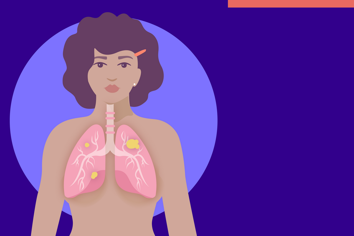Mujeres que nunca han fumado pueden desarrollar cáncer pulmonar