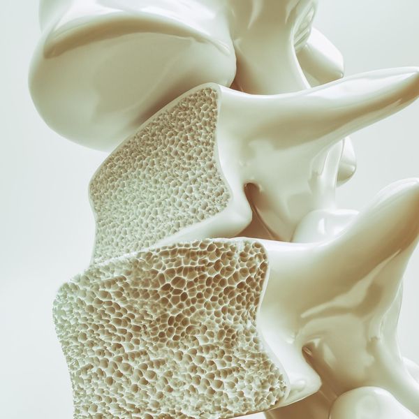 My Family\u2019s History With Osteoporosis Changed My Medical Career Path