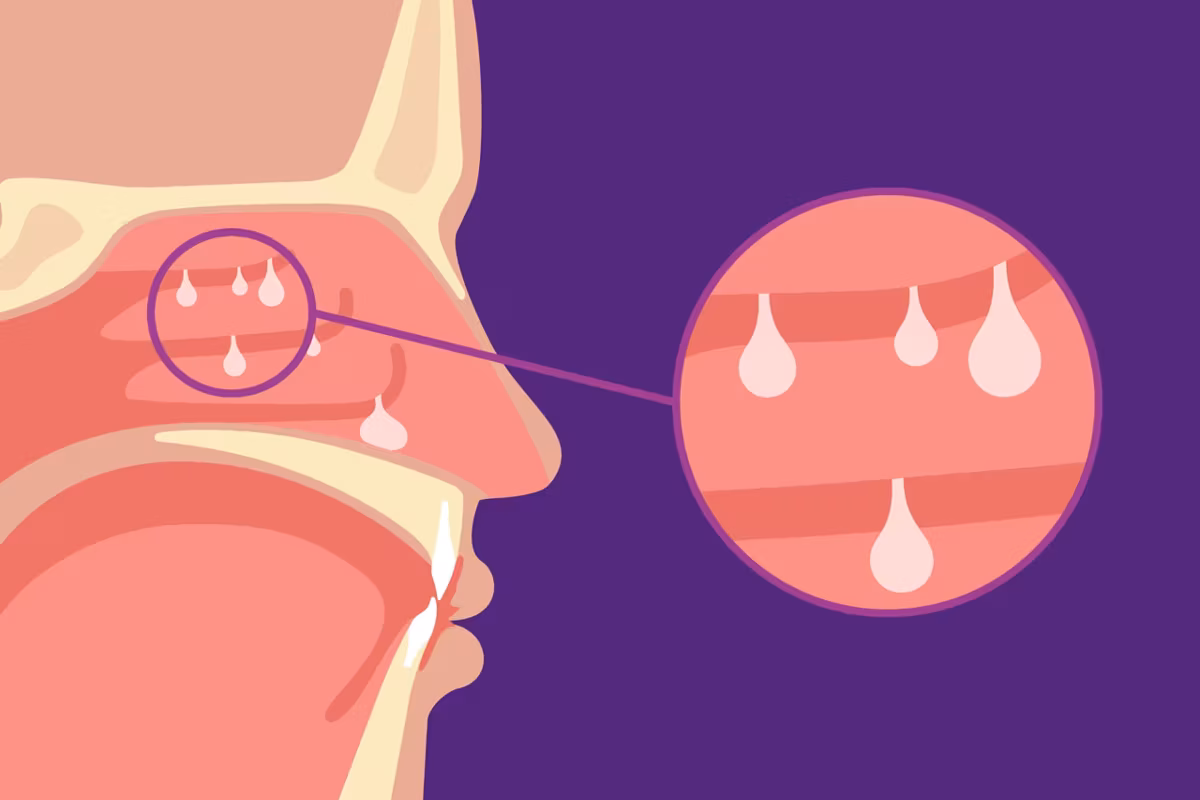 Nasal Polyps and Coexisting Conditions