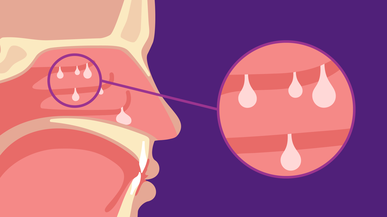 Nasal Polyps and Coexisting Conditions