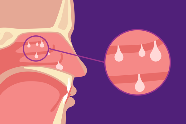 Nasal Polyps and Coexisting Conditions