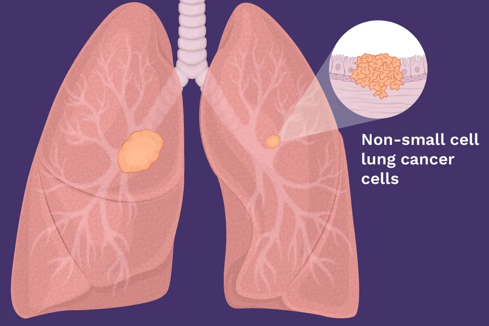 Non-small cell lung cancer