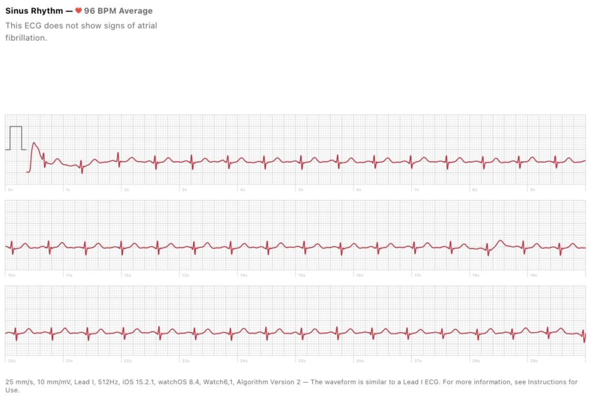 One of Sarah Baumgartenu2019s mobile electrocardiogram reports, 2022