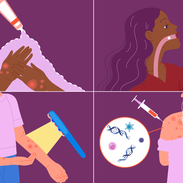 Options for Treating Atopic Dermatitis