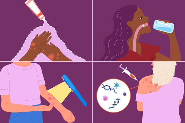 Options for Treating Atopic Dermatitis