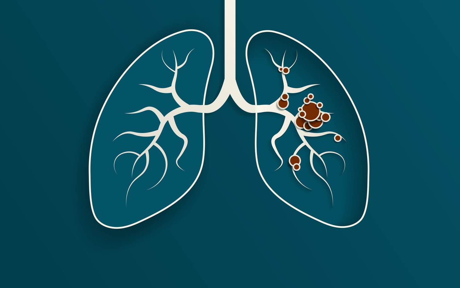 How Do Lung Cancer Biomarkers Help Guide Treatment?