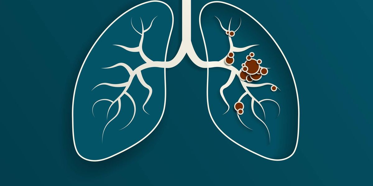 How Do Lung Cancer Biomarkers Help Guide Treatment?