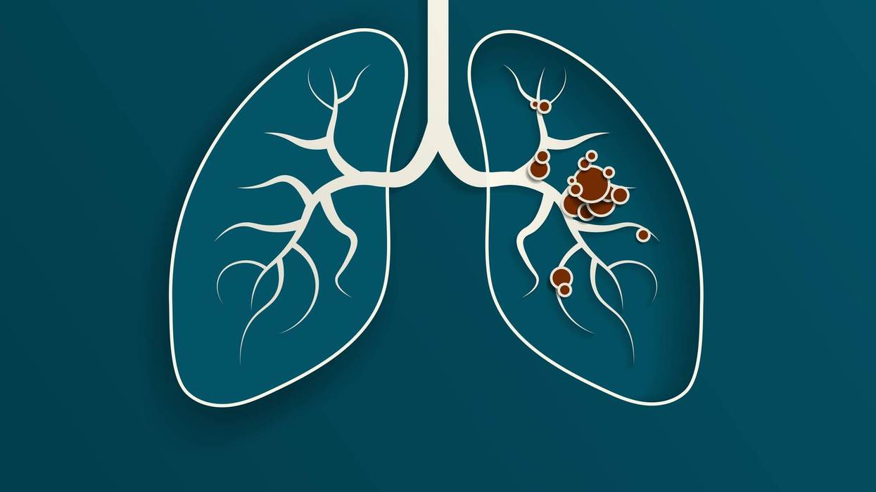 How Do Lung Cancer Biomarkers Help Guide Treatment?