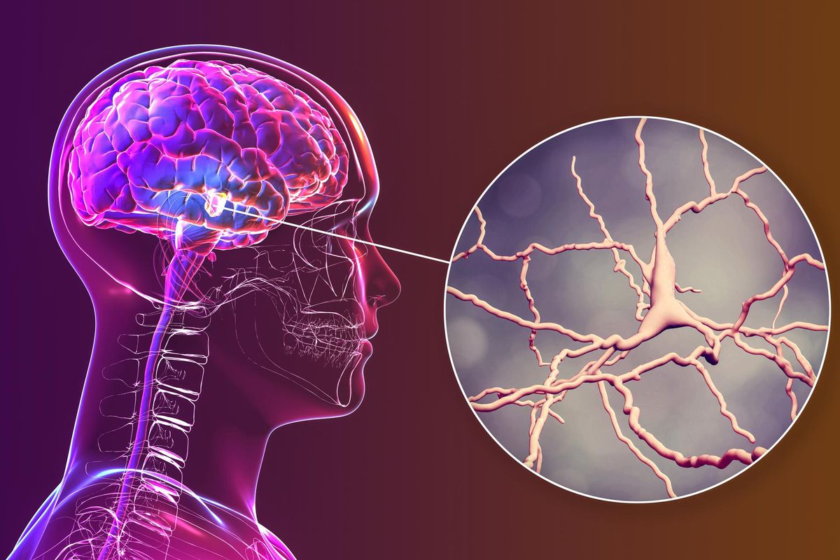 parkinson's affecting the brain