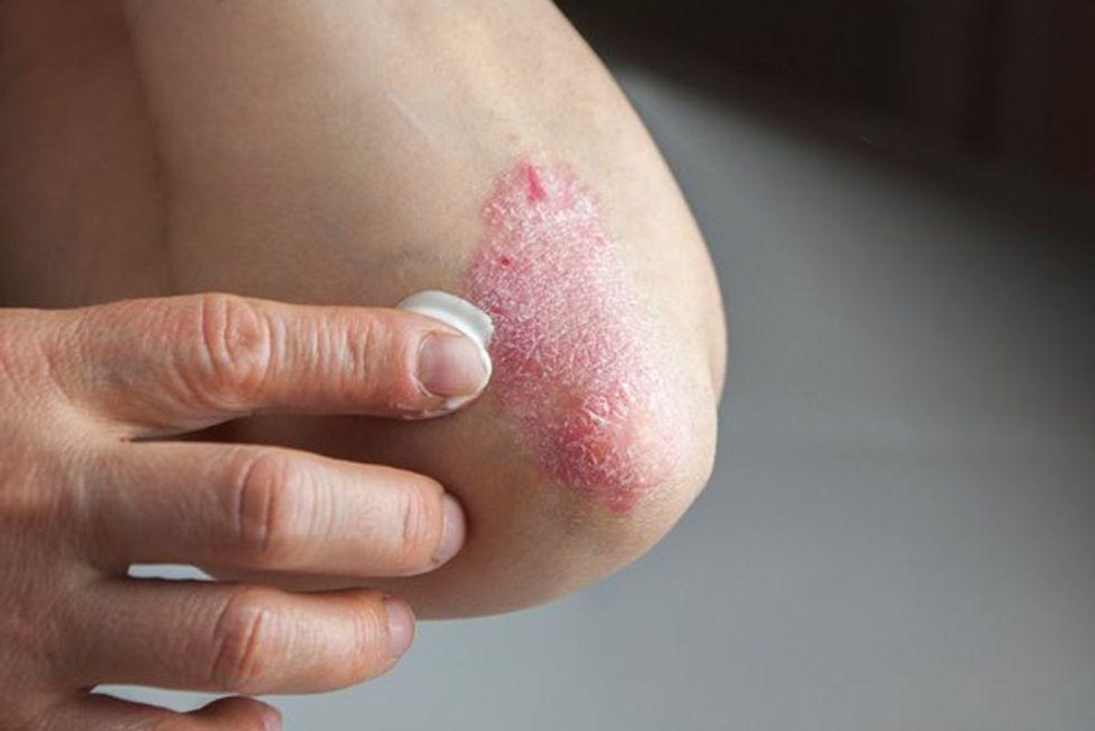 person putting cream on psoriasis outbreak
