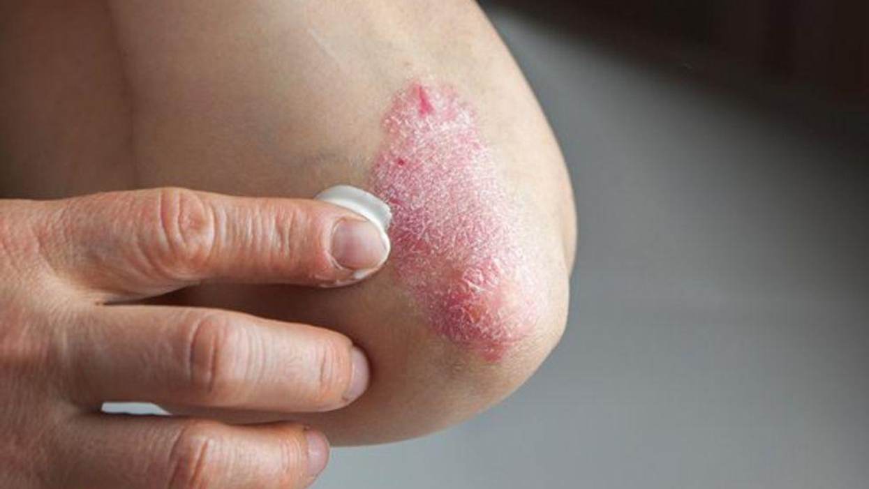 9 Common Misconceptions About Psoriasis