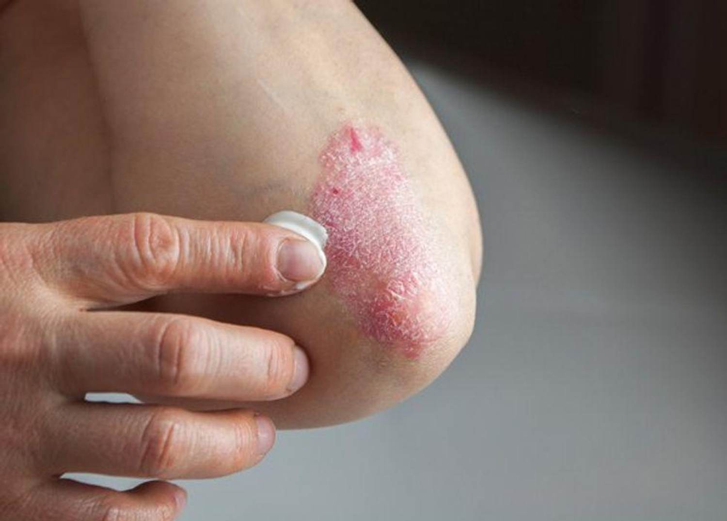 9 Common Misconceptions About Psoriasis