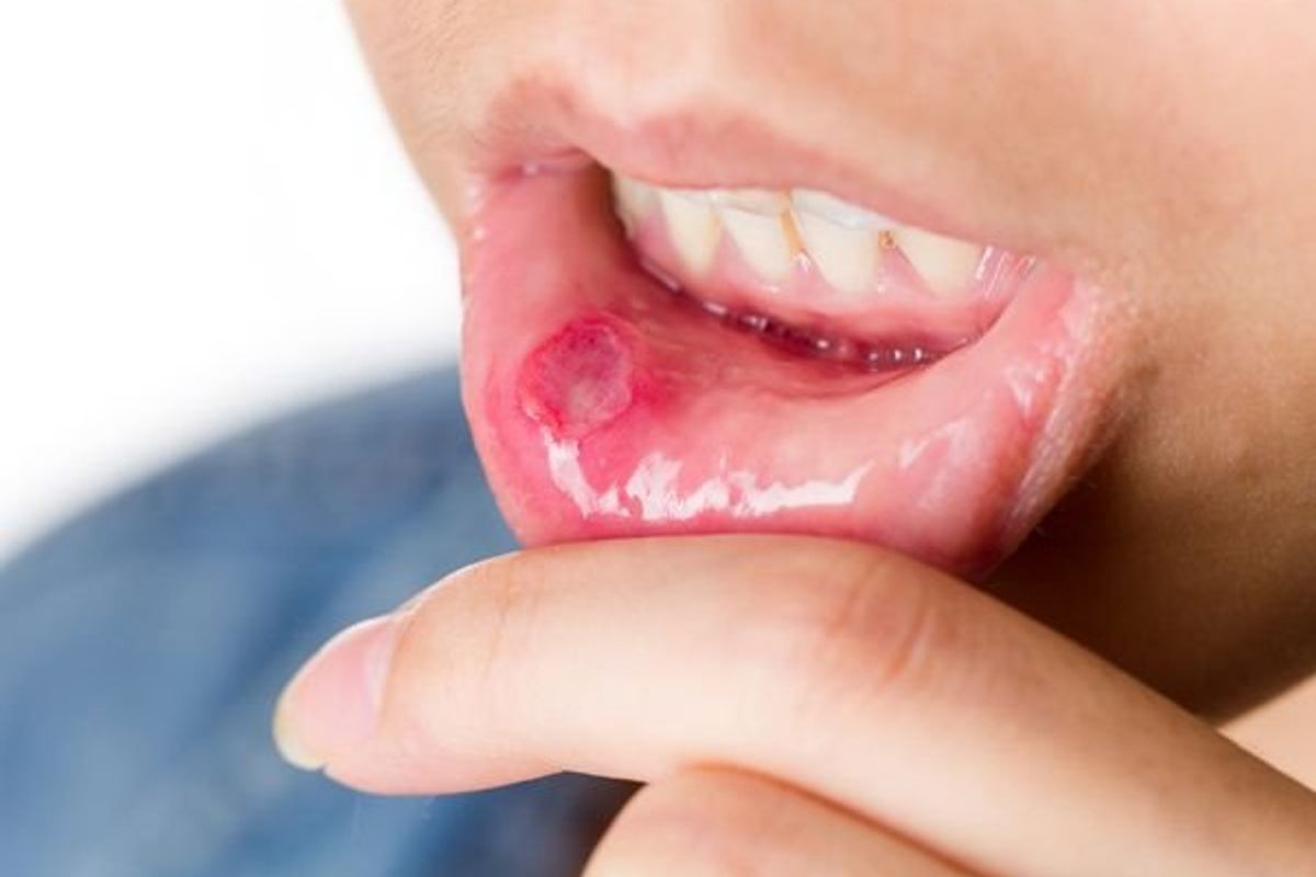 person with a canker sore on their lip