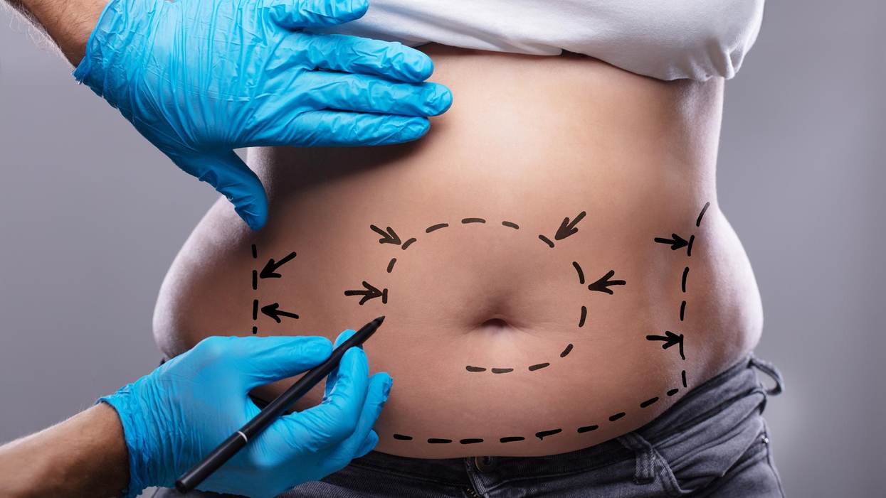 Thinking About Getting a Tummy Tuck? What to Know Before Going Under the Knife.