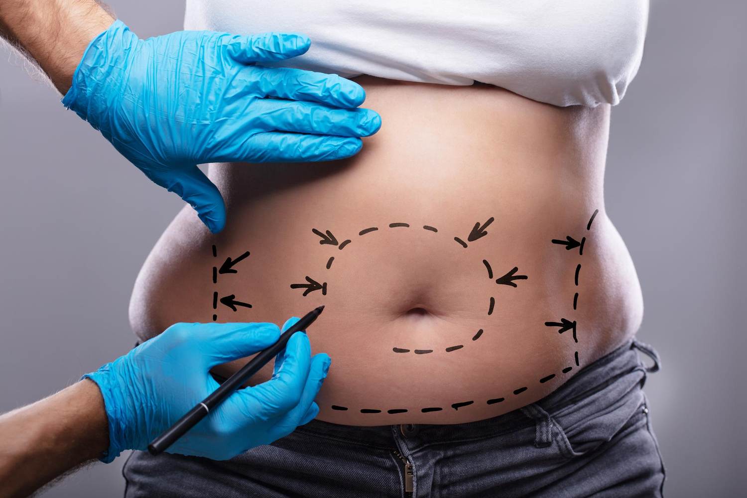 Thinking About Getting a Tummy Tuck? What to Know Before Going Under the Knife.