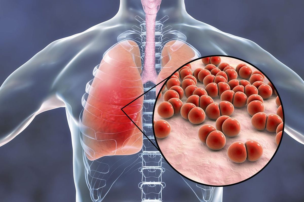 Pneumococcal pneumonia, medical concept