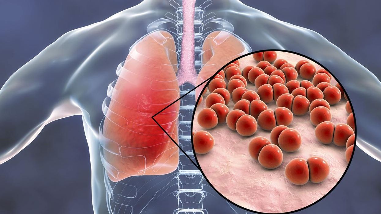 Pneumococcal pneumonia, medical concept
