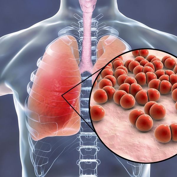 Pneumococcal pneumonia, medical concept