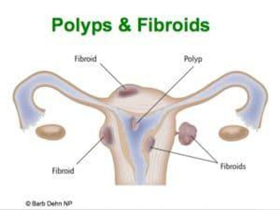 polyps and fibroids in a uterus