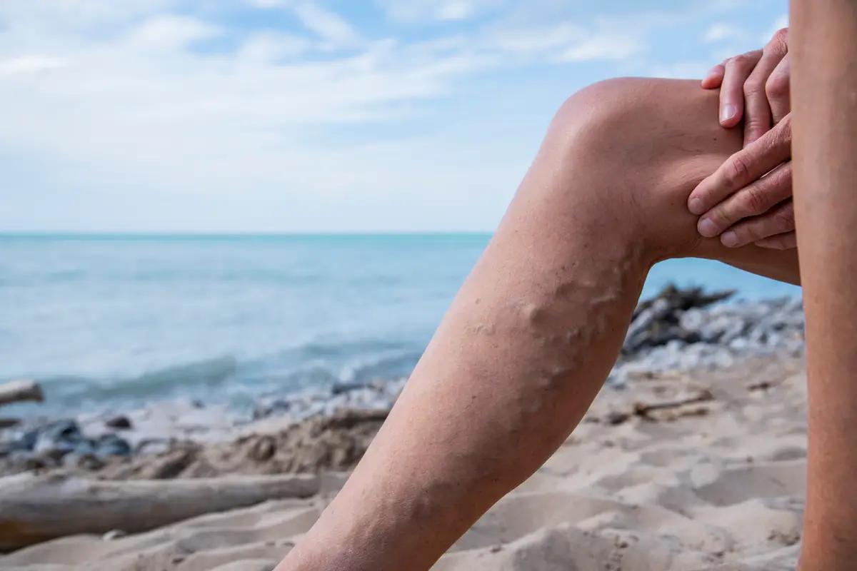 prevent varicose veins