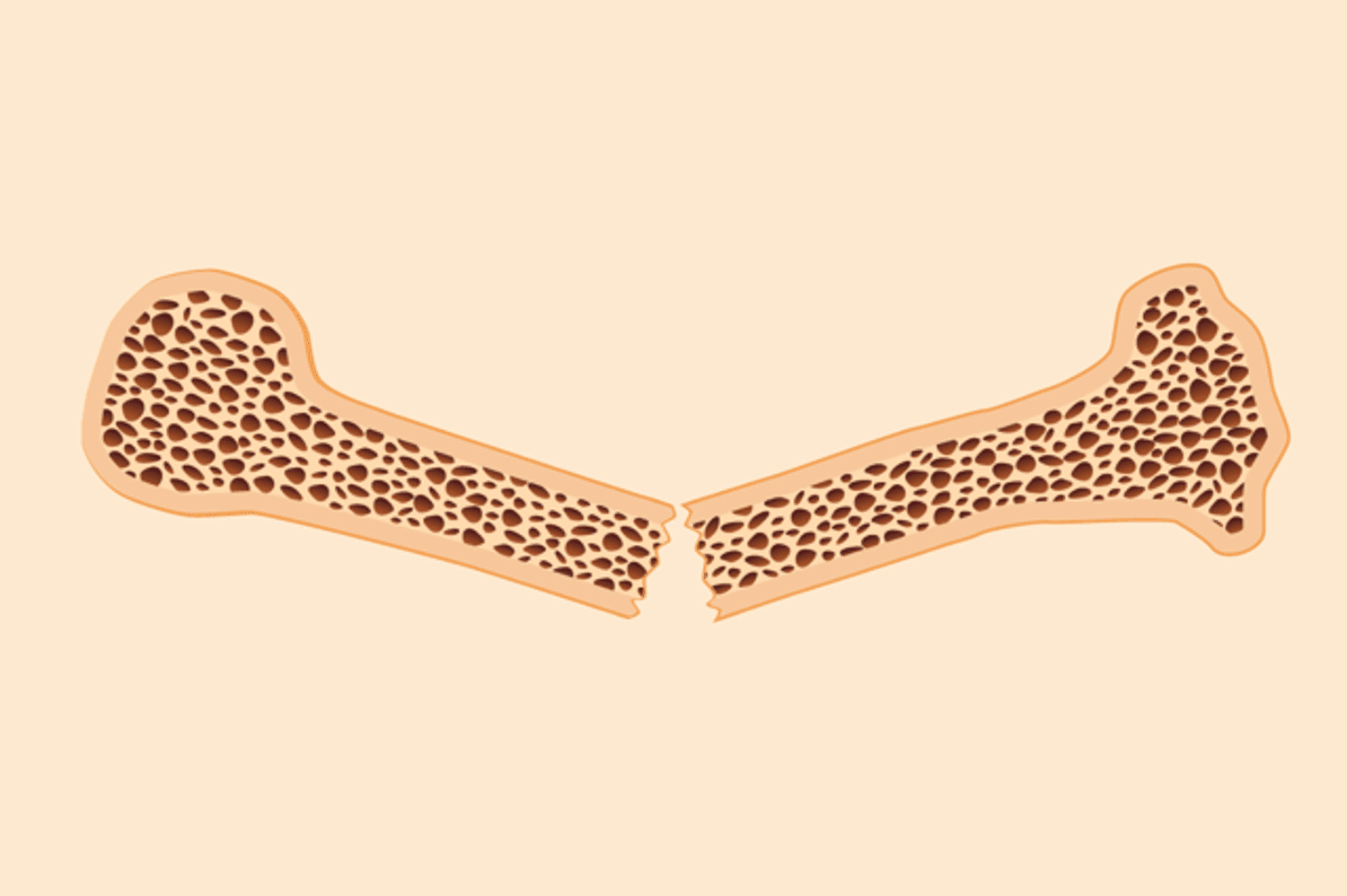 ¿Qué es la osteoporosis y cómo tratarla?