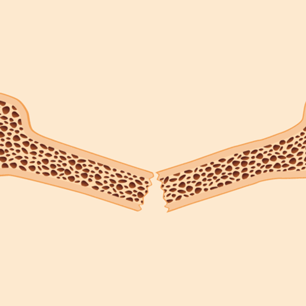 ¿Qué es la osteoporosis y cómo tratarla?