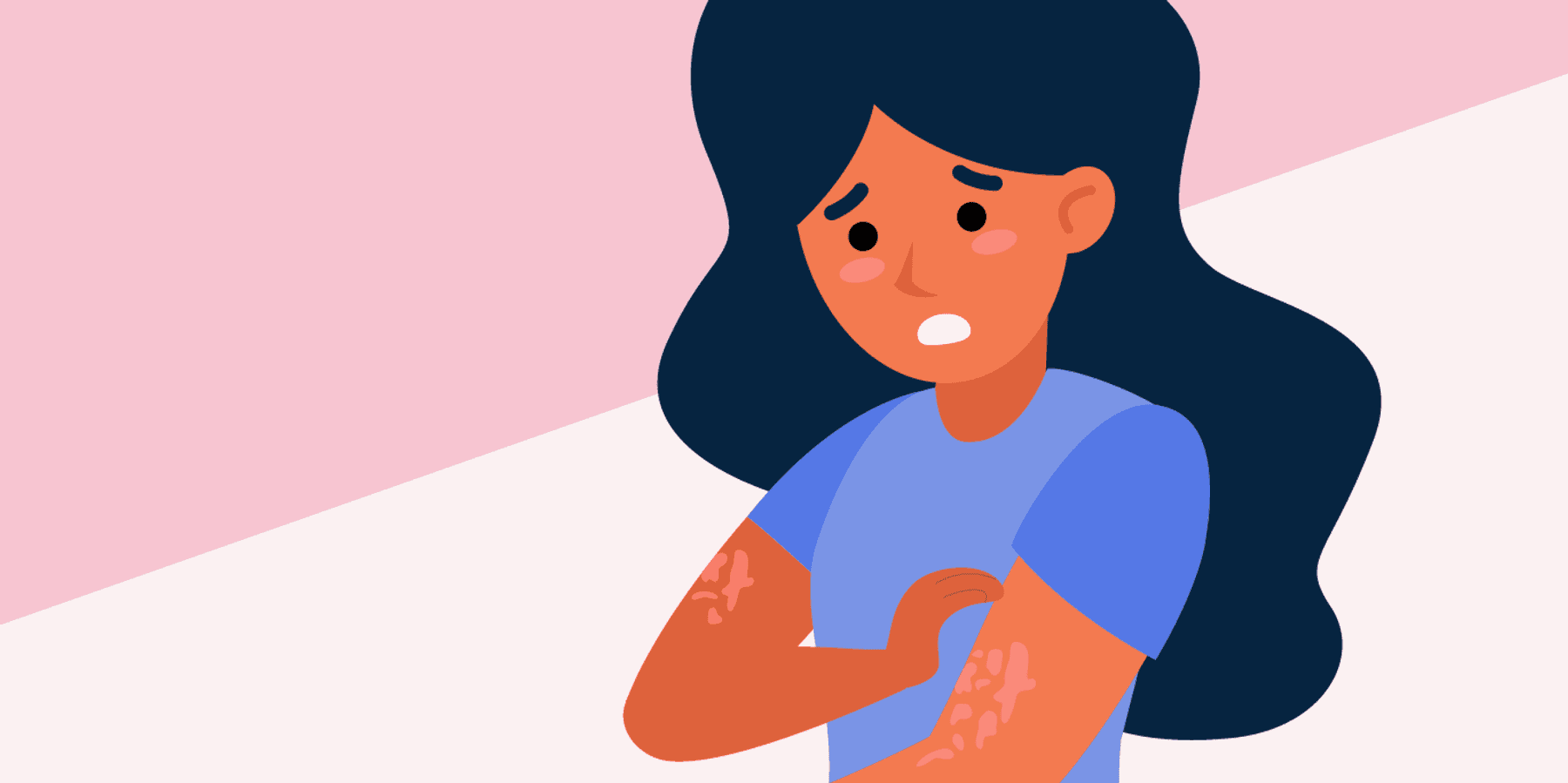 ¿Qué es la urticaria crónica espontánea (UCE)?