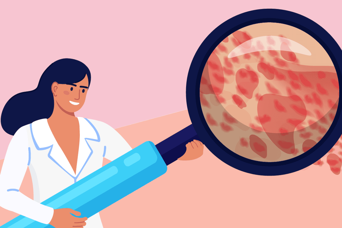 ¿Qué es la urticaria crónica espontánea?