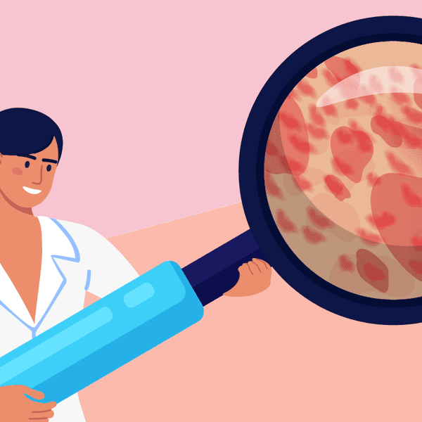¿Qué es la urticaria crónica espontánea?