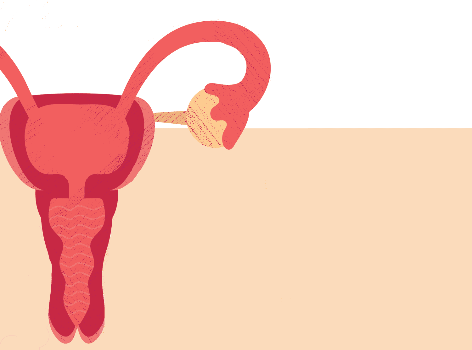 Radiofrequency Ablation (RFA) Is a Treatment Option for Fibroids